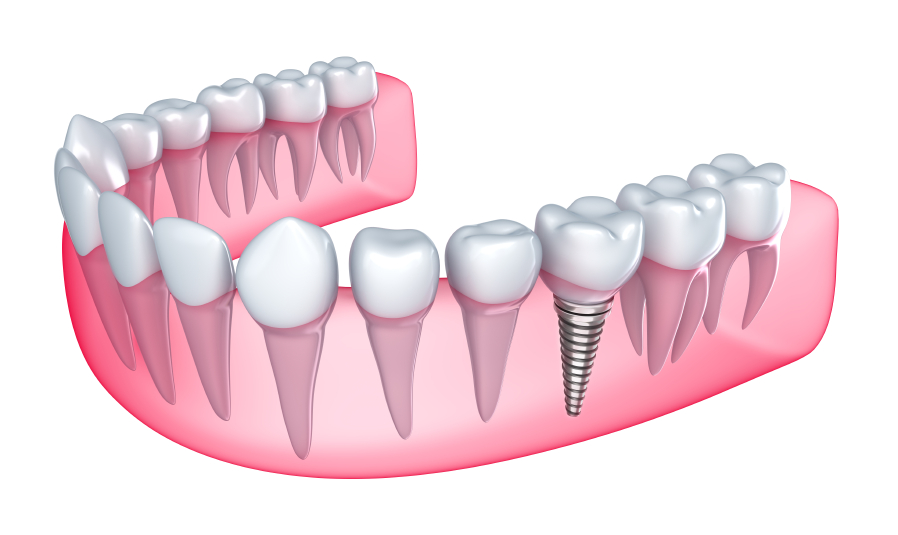 A dental implant in a 3d rendering