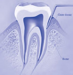 Periodontal Gum Disease