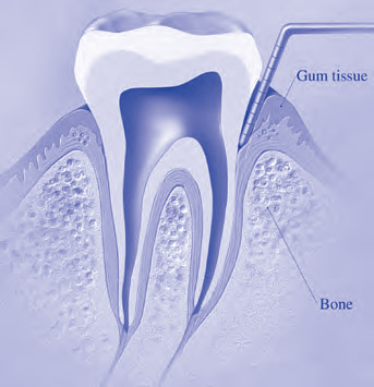 Periodontal Scaling and Root Planing