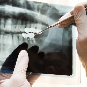 An X-ray of a dental implant to fix