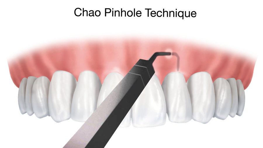 Arizona Periodontal Group Offers the Pinhole Surgical Technique!