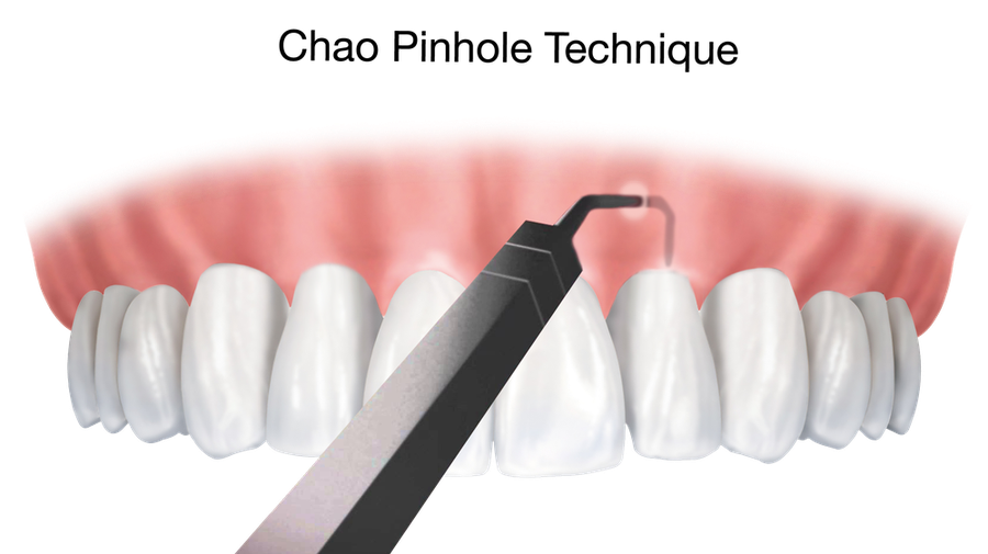 Goodbye, Gum Grafts! Hello, Pinhole Surgical Technique!