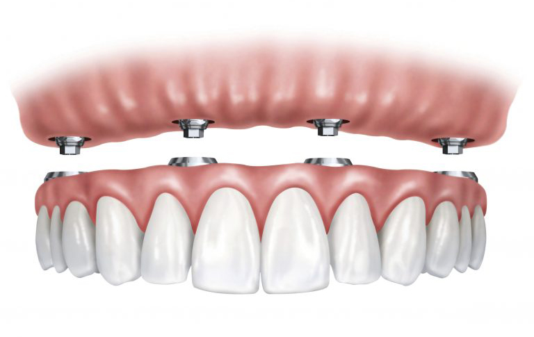 Illustration of All-On-4 Dental Implants
