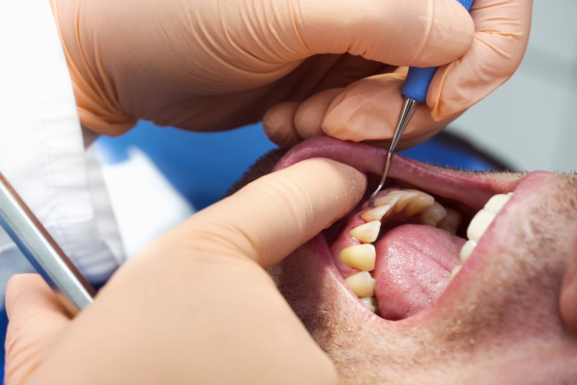 A man's mouth is treated for gum disease with LANAP alternative surgery.