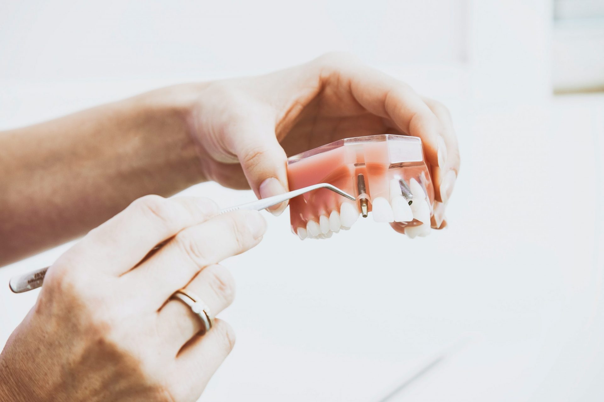 A model of a dental implant.