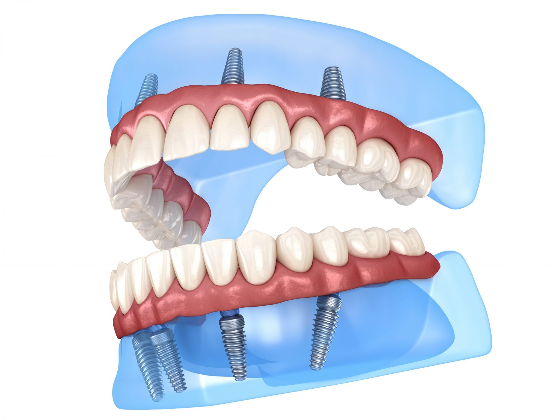 All-On-4 teeth in a day dental implants 3D rendering.