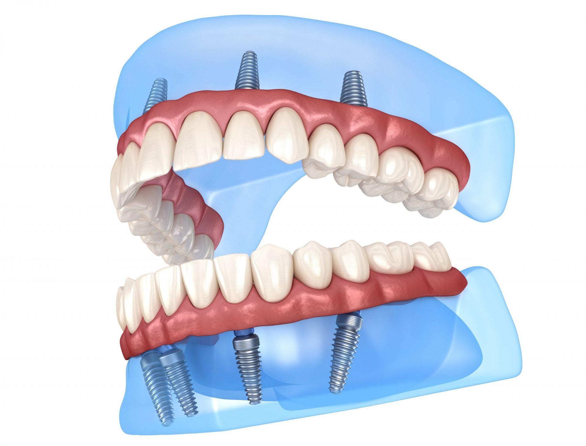 Teeth-In-A-Day: Everything You Need to Know About All-On-4®