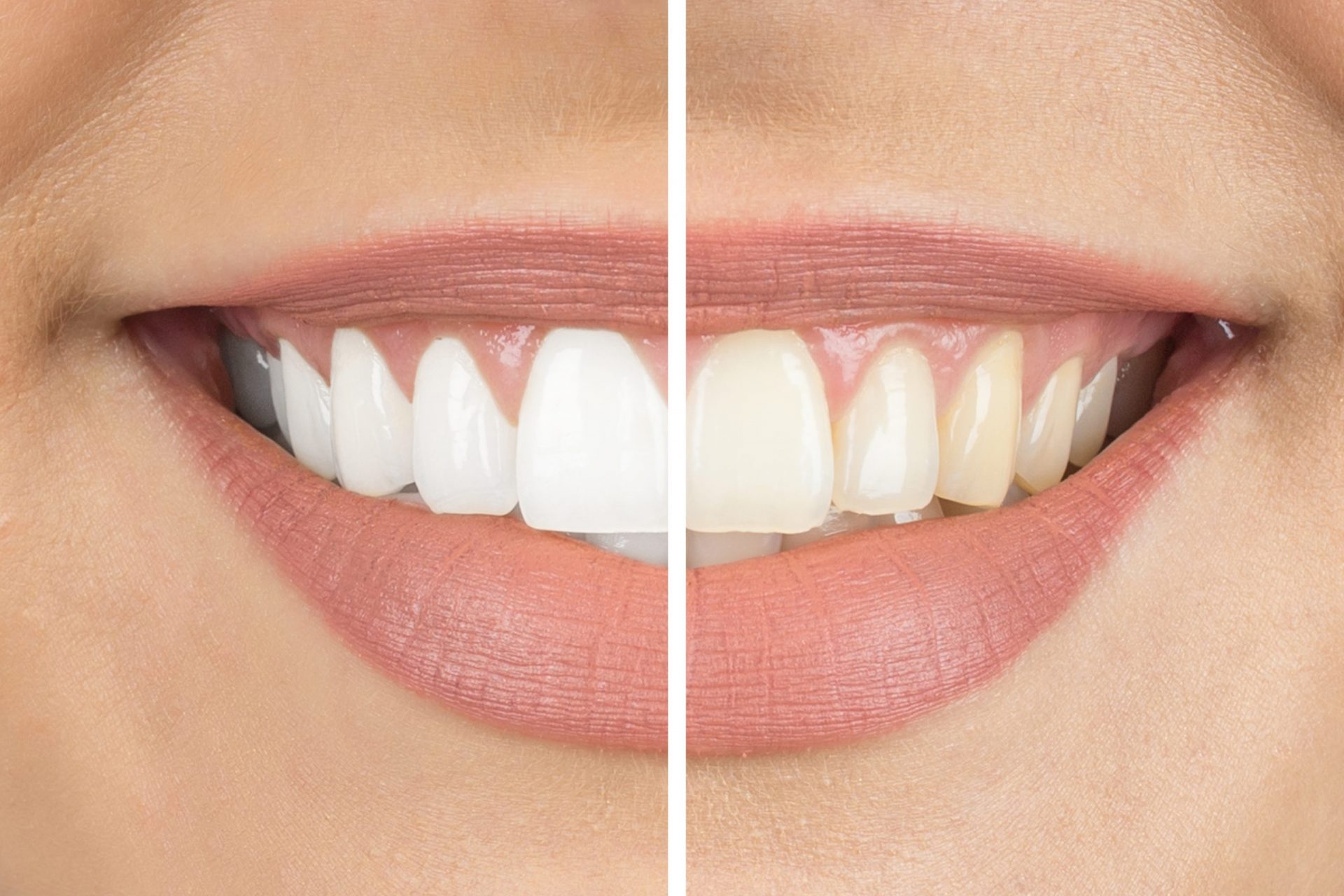 Cosmetic Teeth whitening before and after
