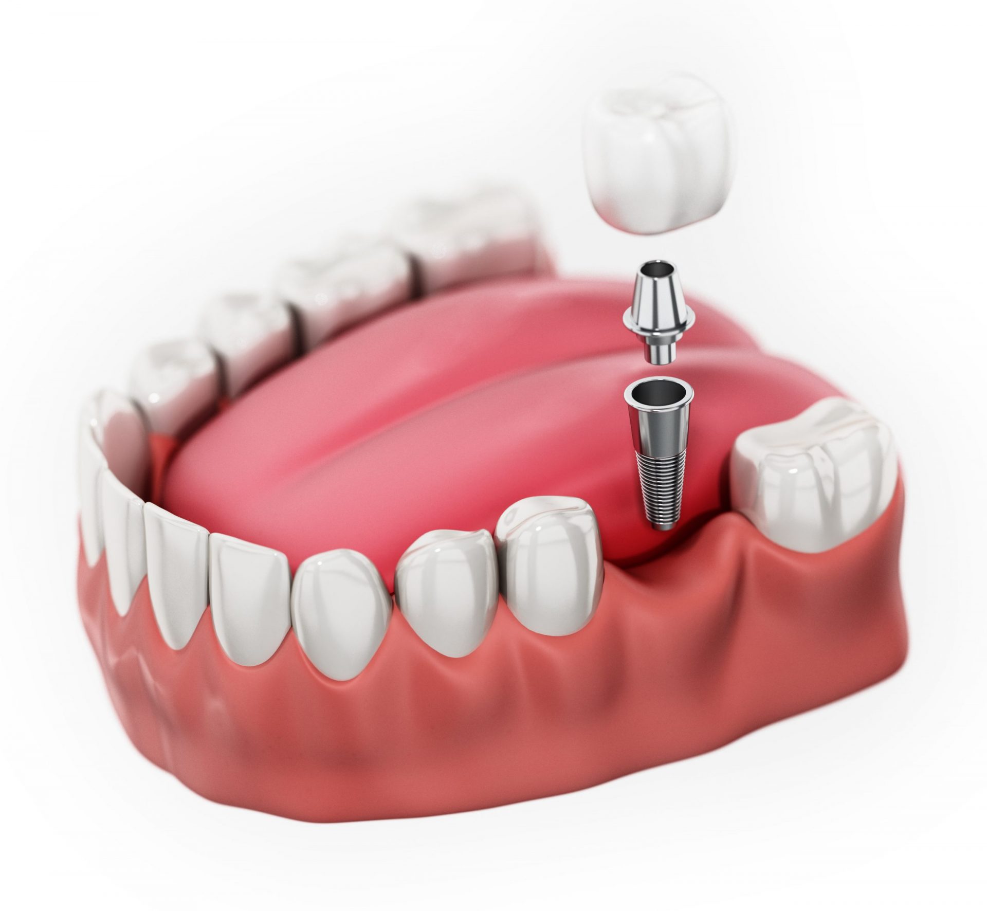 3D rendering of a single tooth dental implant