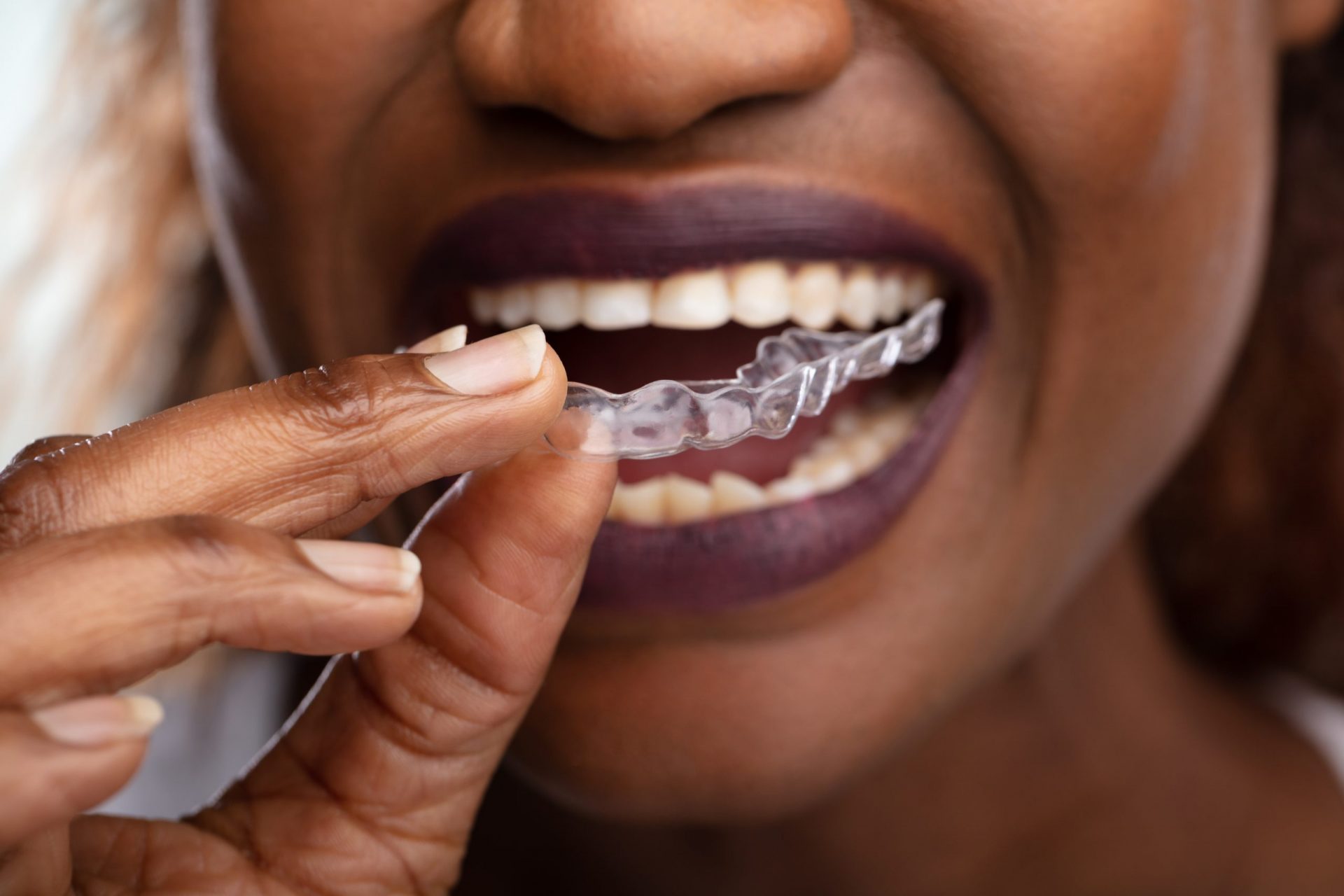 Mouth guard for bruxism treatment
