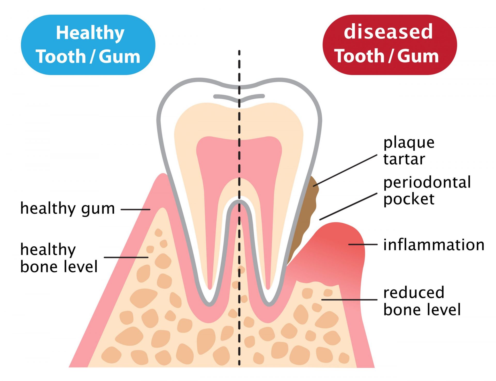 Healthy vs periodontal diseased tooth and gums illustration