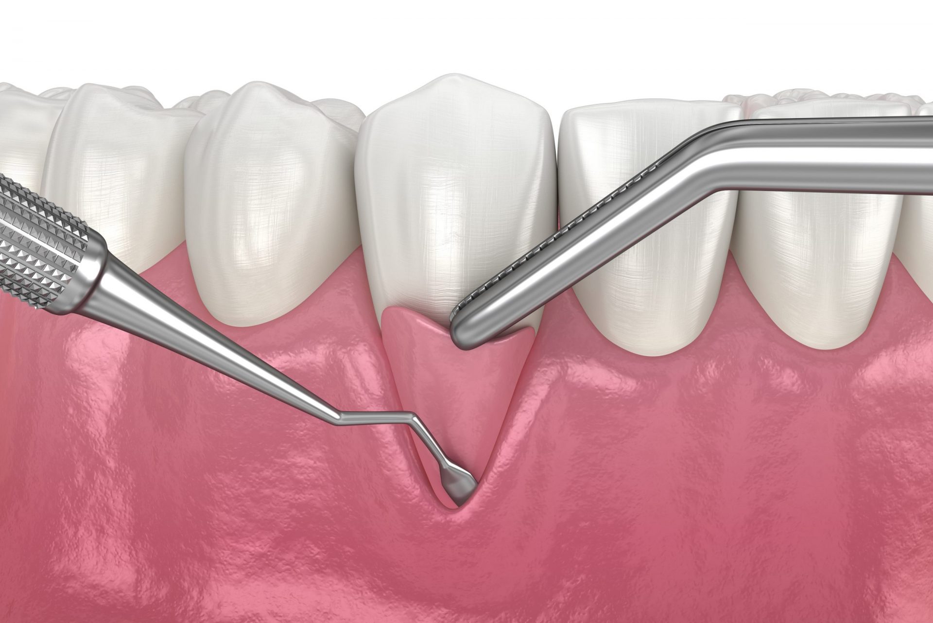 3D rendering of gum graft surgery