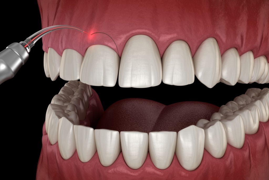 Gingivectomy procedure 3D illustration