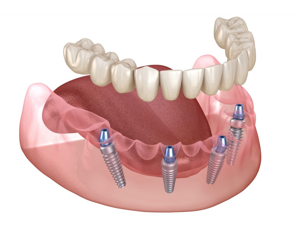 3D rendering of All-on-4 dental implants