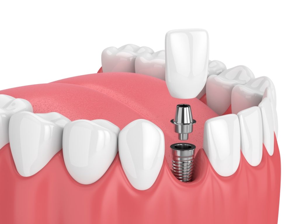 3d render of jaw with teeth and dental incisor implant