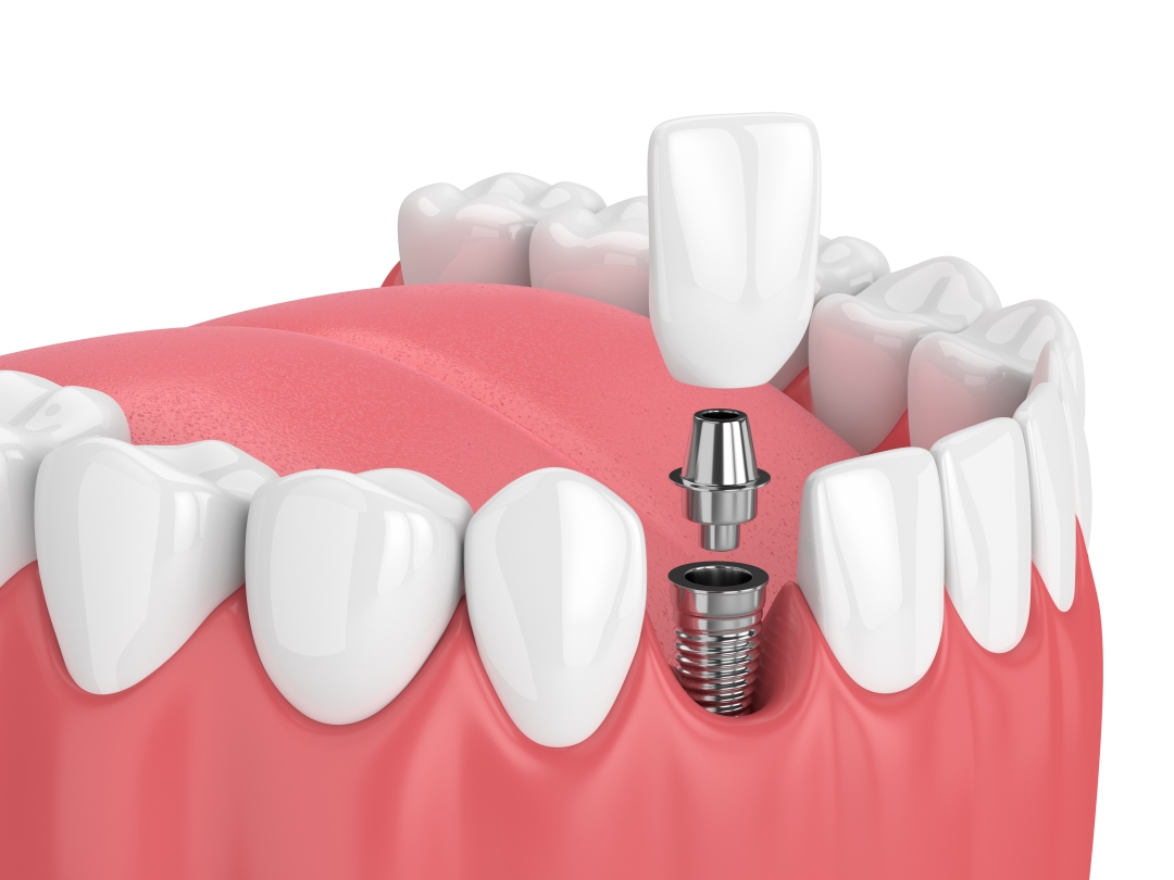 Answering Your Dental Implant Questions Arizona Periodontal Group