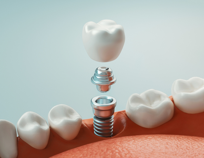dental implant vector image