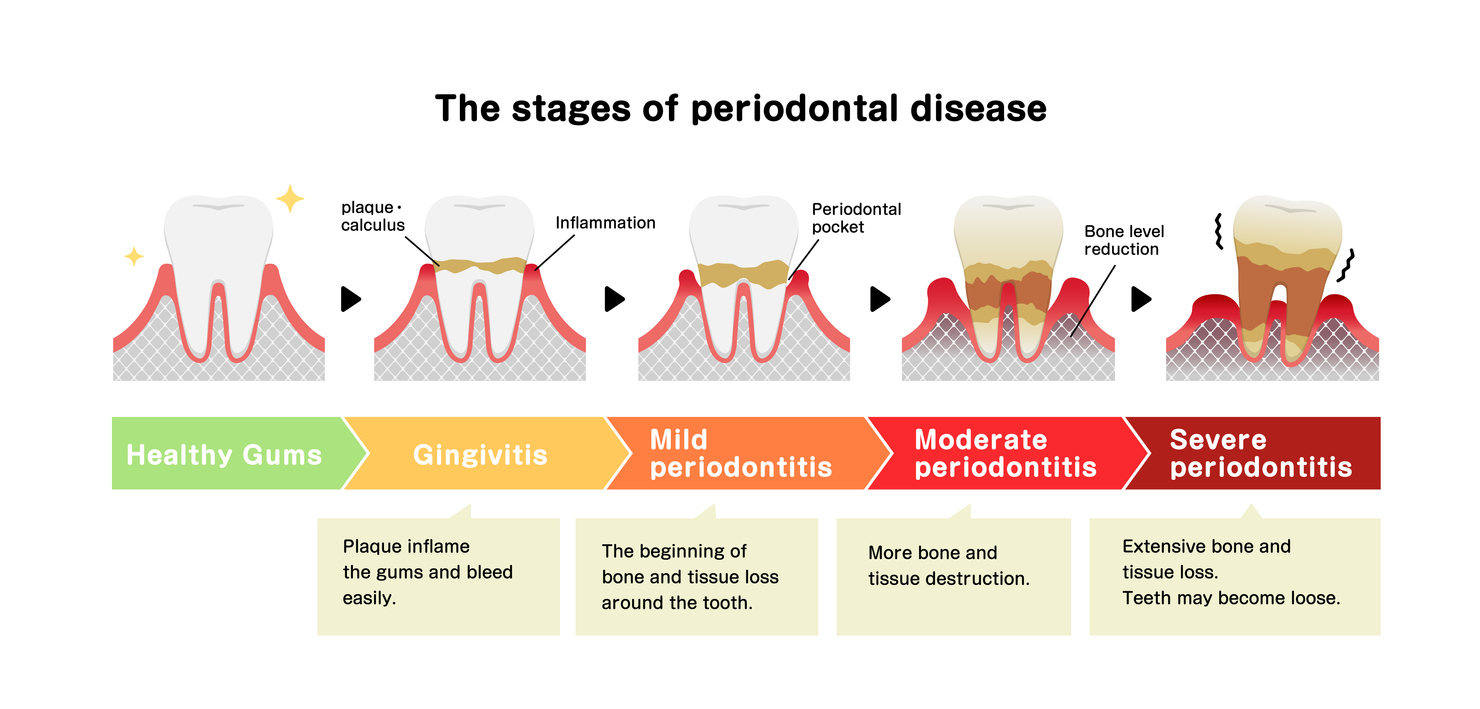 The 5 Stages of Gum Disease: Signs, Symptoms, and Treatment - Old