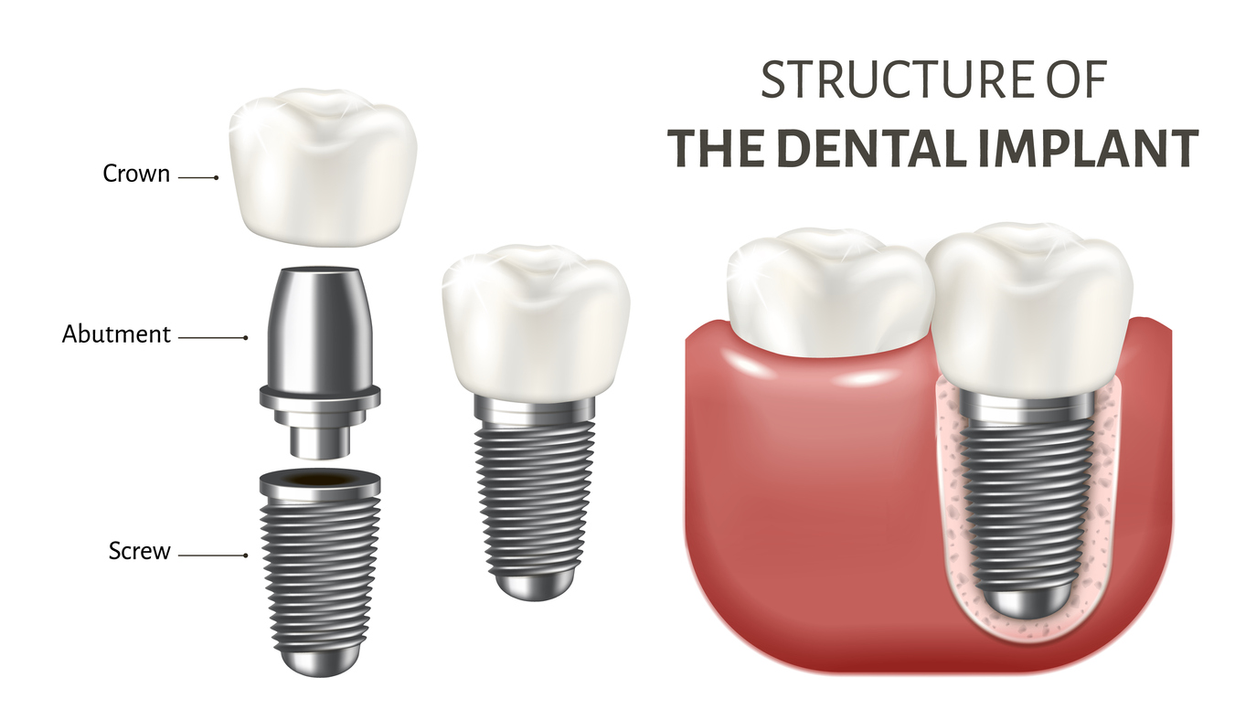 Structure of a dental implants