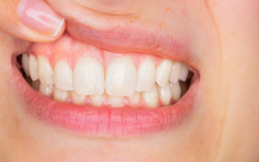 woman's teeth