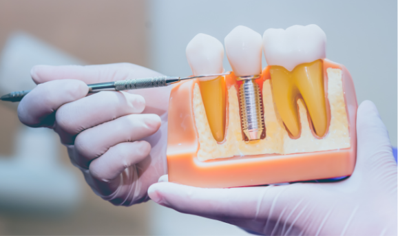 Dental implant model