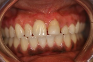 gum bleaching after