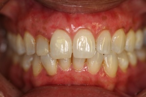 gum depigmentation after