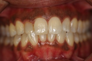 gum depigmentation before