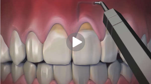Pinhole surgical technique video - receding gum therapy