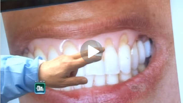 Pinhole surgical technique video 2 - receding gum therapy