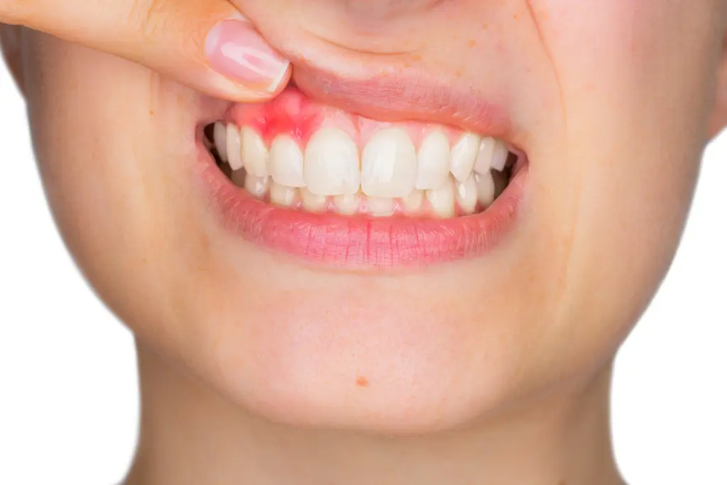 5 Ways to Tell if you Might Have Gum Disease