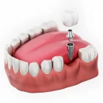 single dental implants 3D image
