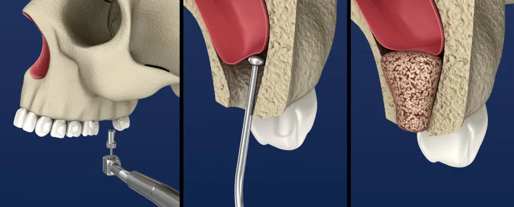 Sinus Lift Surgery - Sinus Augmentation. 3D illustration