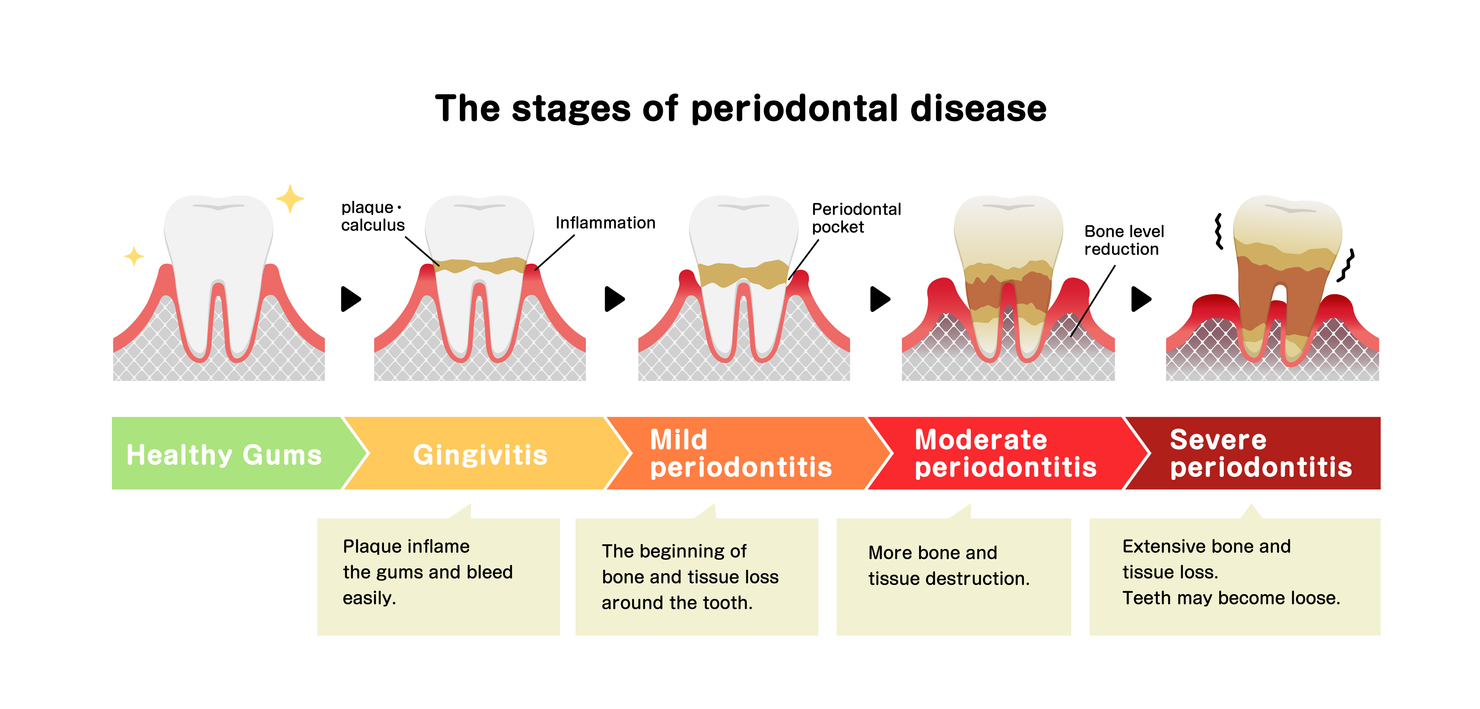 Se puede salvar un diente con periodontitis