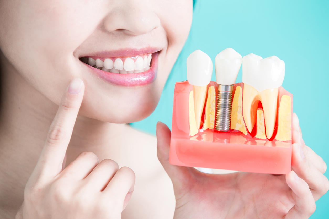 Woman holding dental implant model