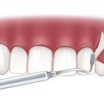 Gum Recession Treatment of soft tissue with gum graft surgery.