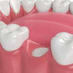 bone graft for dental implant