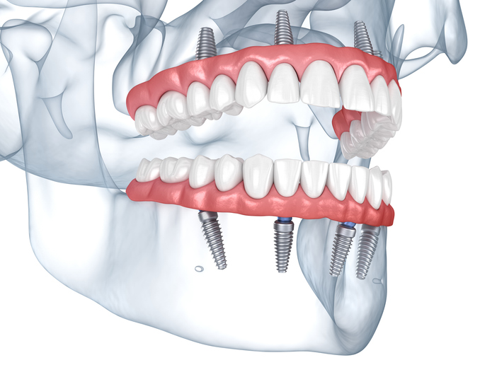 Same day dental implants All-on-4 implants.