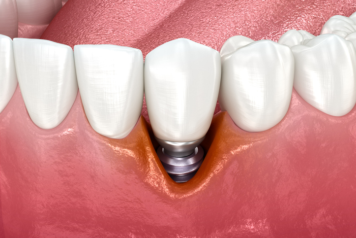 peri-implantitis: dental implant with infection