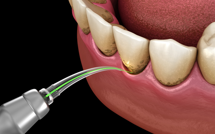 LANAP uses a specialize laser to treat gum disease