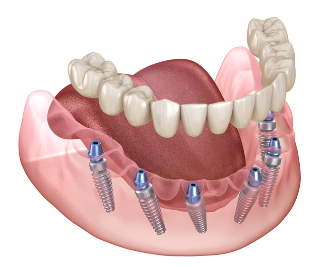 All-on-6 dental implants 3d illustration
